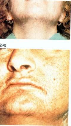 Severe hirsutism Male type