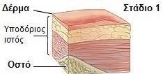 3. ΣΤΑΔΙΟΠΟΙΗΣΗ ΤΩΝ ΕΛΚΩΝ ΠΙΕΣΗΣ Τα έλκη πίεσης κατατάσσονται σε τέσσερα στάδια: ΣΤΑΔΙΟ 1 Ο Άθικτο δέρμα με μη εφυάλωτη ερυθρότητα μιας τοπικής περιοχής συνήθως πάνω σε οστέινη προβολή.