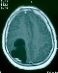 enhanced nodule