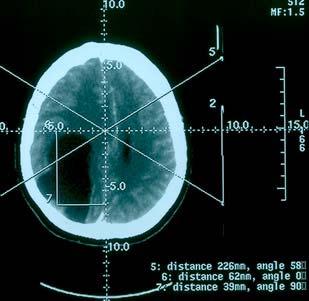 excision of the nodule, on a