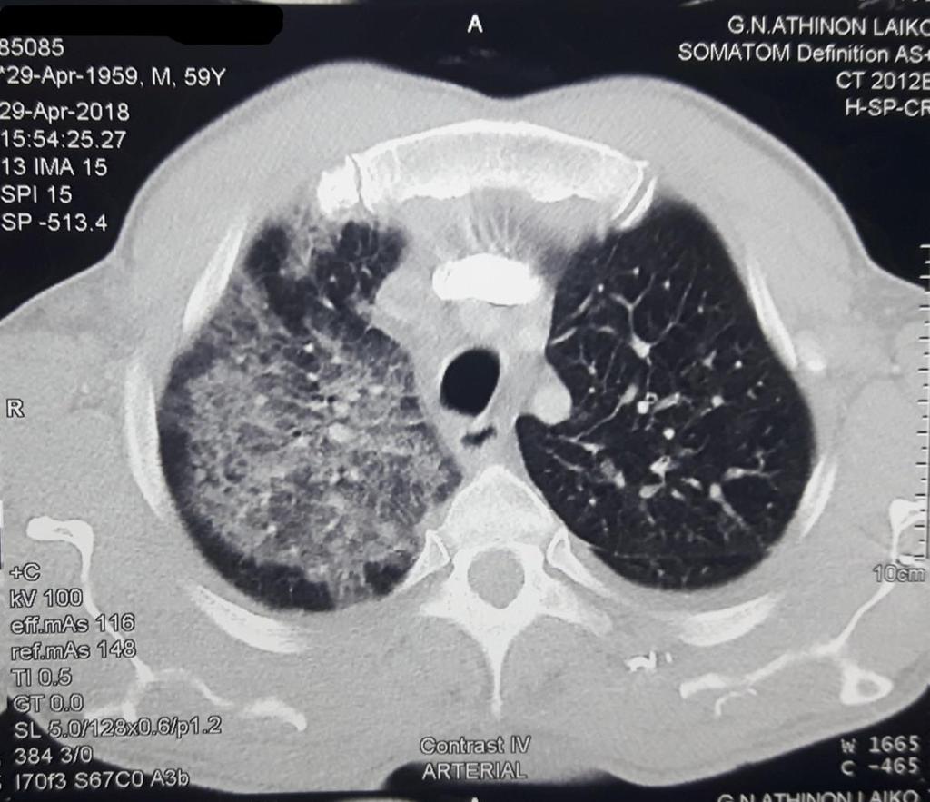 ΠΟΡΕΙΑ ΝΟΣΟΥ ΙΙ: Ο πατέρας εμφάνισε βήχα παραγωγικό με αιμόφυρτα πτύελα και συνοδό υποξυγοναιμία. Διενεργήθηκε επείγουσα CTPA η οποία δεν ανέδειξε εικόνα πνευμονικής εμβολής.