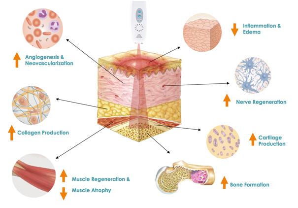 ολική καταστροφή των κυττάρων. Η ακτίνα του cold Laser φθάνει στα κατώτερα υποδόρια στρώματα του δέρματος και δρα θεραπευτικά (Bio-Stimulation) στο μεταβολισμό των κυττάρων.