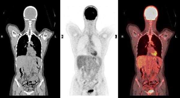 PET scan: