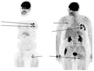PET scan: μη