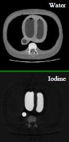 νερό (soft tissue) και ιώδιο (contrast media) Ιδεατή