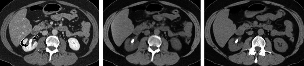 (VNC) imaging] Εικόνα μετά τη χορήγηση σκιαγραφικού