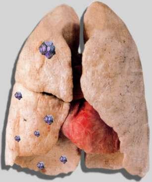 Η Σταδιοποίηση του καρκίνου του πνεύμονος έχει πολύπλευρη σημασία.