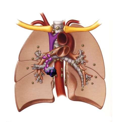 Ως Τ4 ταξινομείται -ο όγκος οιουδήποτε μεγέθους με διήθηση της καρδιάς, των μεγάλων αγγείων, της τραχείας, του παλίνδρομου λαρυγγικού νεύρου, του