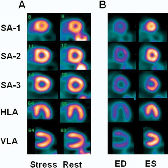 A, Normal stress and rest 82Rb PET images.