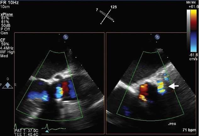 Διαδερμική Αντιμετώπιση Σύγκλεισης Παραβαλβιδικών Διαφυγών της Αορτής Posteriorly located leaks: transesophageal echocardiography is preferable Anteriorly located