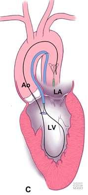 technique Arterioarterial Rail Technique The