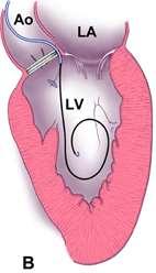 crossing of the defect is smooth and the leak is likely