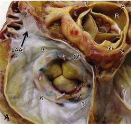 Krishnaswamy et al. thoracickey.com To locate and assess different leaks on 2D echo needs a careful search.