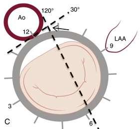 appendage The TEE planes are shown on the mitral valve clock face (LV view)