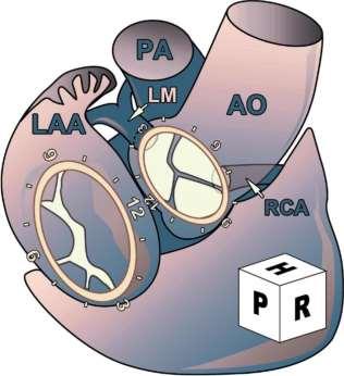Διοισοφάγειο Υπερηχογράφημα - Αορτική Βαλβίδα NC R L the noncoronary cusp is between 7 o'clock and 11