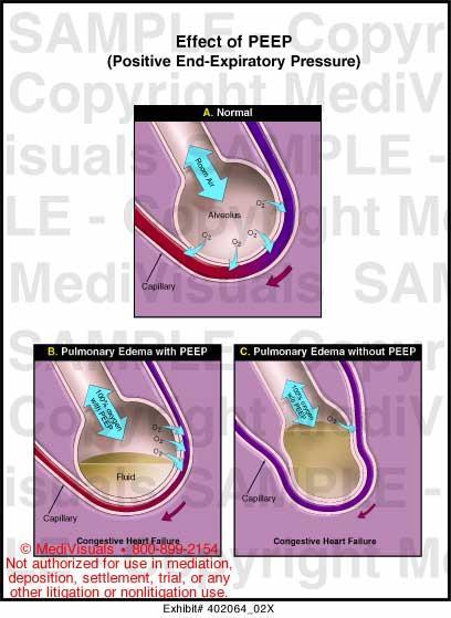 Expiratory