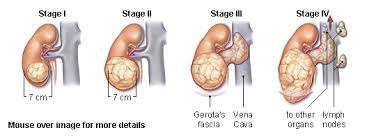 Τ Primary tumor Tx Primary tumor cannot be assessed T0 No evidence of primary tumor T1 Tumor 7cm in greatest dimension, limited to the kidney T1a tumor 4cm in greatest dimension, limited to the