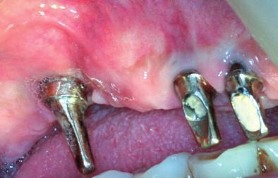 86 Περιοδοντολογικά Ανάλεκτα Τόμος 25 (2016) Analecta Periodontologica Volume 25 (2016) 12 εβδομάδες/12 weeks 12 εβδομάδες/12 weeks Ε/Mesial Μ/Middle Α/Distal PI ΠΑΡ/BUC ΓΛΩΣ/LING BoP ΠΑΡ/BUC