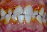 ςυνδυαςμόσ των 1 και 2 Η οδοντικι πλάκα προςκολλάται: 1. ςτακερά ςτισ οδοντικζσ επιφάνειεσ 2.