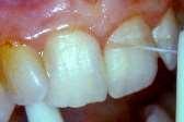 Η ορκι εφαρμογι του οδοντικοφ νιματοσ αφορά ςτθν απομάκρυνςθ: 1. κυρίωσ τθσ υπερουλικισ πλάκασ 2. μζρουσ και τθσ υποουλικισ πλάκασ 3. του λευκοφ επιχρίςματοσ 4.