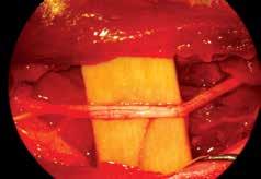 Πρακτική Άσκηση στη Mικροχειρουργική 81 b ΕΙΚΟΝΑ 87 Το ισχιακό νεύρο του επίμυος. Είναι εμφανές το αγγείο που διατρέχει επιμήκως το νεύρο.