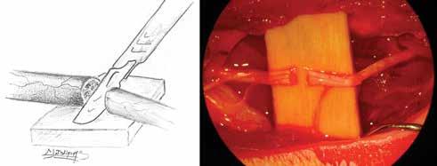 Τοποθετείται κλασσικό χειρουργικό πεδίο και ξεκινά η επινευρική συρραφή με ράμμα nylon 9-0 ή 10-0, προσέχοντας η βελόνα του μικροράμματος να διέρχεται μόνο από