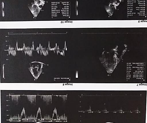 Δημογραφικά Σύντομο ιστορικό Διάγνωση: σοβαρού βαθμού ΑoS Echo καρδιάς: καλό μέγεθος LV, LA με αυξημένες