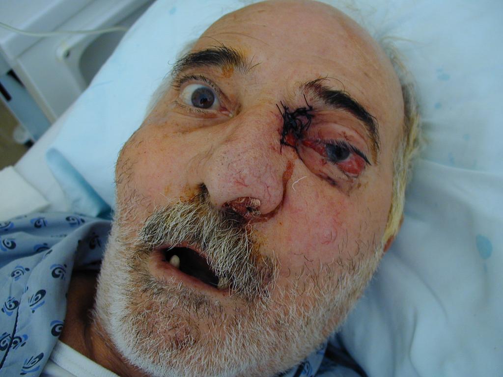 Άνδρας 67 ετών με εικόνα ταχέως εξελισσόμενης σπειραματονεφρίτιδας στα πλαίσια αγγειίτιδας, αντιμετωπίζεται επιτυχώς με medrol (3gr bolus=>1mg/kβσ) και