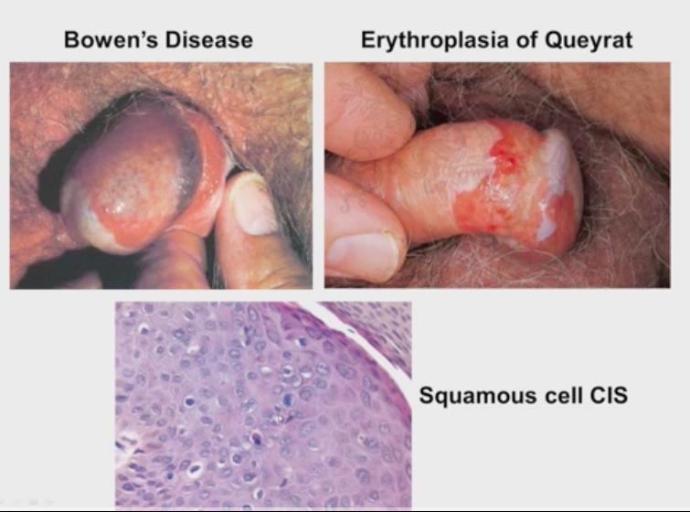 Νόσος του Bowen ΔΔ: Μποουενοειδής βλατίδωση Ψωρίαση