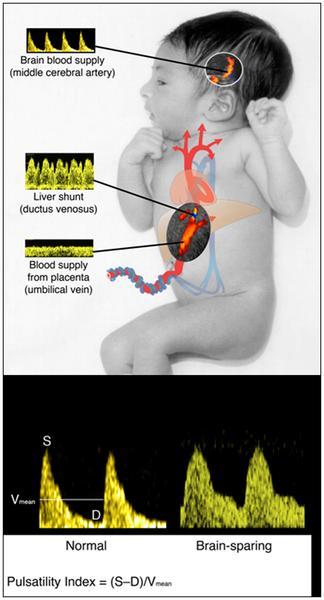 Εικόνα 5 Πηγή: Kiserud T, Stratford L & Hanson MA (1997) Umbilical flow distribution to the liver and ductus venosus: an in vitro investigation of the fluid dynamic mechanisms in the fetal sheep.