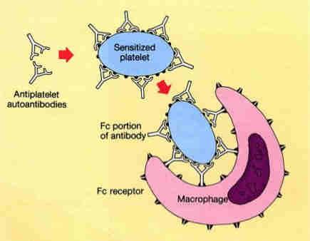 Ιδιοπαθής Θροµβοπενική Πορφύρα ή Immune Thrombocytopenic Purpura Παράγονται αυτό-αντισώµατα εναντίον των αιµοπεταλίων Τα αιµοπετάλια αυτά καταστρέφονται από τα µακροφάγα στον σπλήνα.