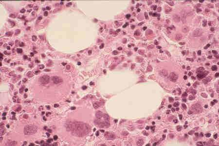Ιδιοπαθής Θροµβοκυττάρωση WHO διαγνωστικά κριτήρια 16 1.Θροµβοκυττάρωση (>450 x 10 9 /l) για >2 µήνες 2. Αύξηση στον µυελό του αριθµού των Μεγακαρυοκυττάρων 3.