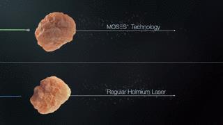 MOSES Holmium Laser 60% retropulsion 25% μέγεθος των