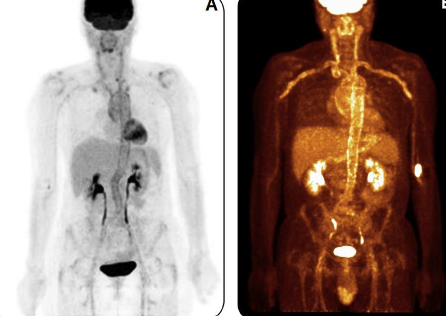Έλεγχος προσβολής μεγάλων αγγείων 18 F-FDG PET/PET CT Πρόσληψη ραδιοφαρμάκου από μεταβολικά