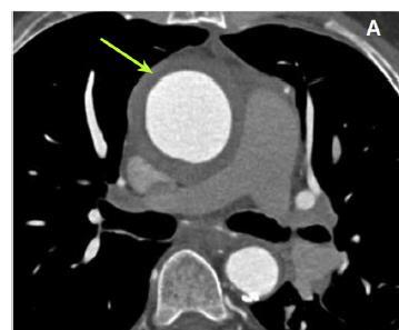 κλασσικής αγγειογραφίας Dejaco C et al, Ann Rheum