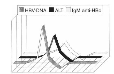 To anti HBc IgM ο κύριος διαγνωστικός ορολογικός δείκτης της οξείας ηπατίτιδας Β μπορεί να αυξηθεί σε υψηλούς τίτλους στις οξείες αναζωπυρώσεις της χρόνιας ηπατίτιδας Β Puri