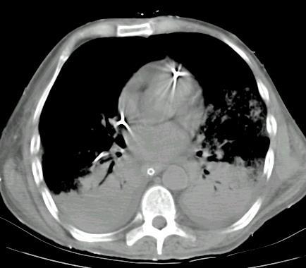 Lung Protection: Scaling the delivered tidal volume VT 6 ml/kg VT VT