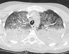 Lung stress, Transpulmonary