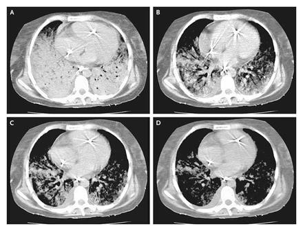 ARDS: Lung protective ventilation Χειρισμοί στράτευσης