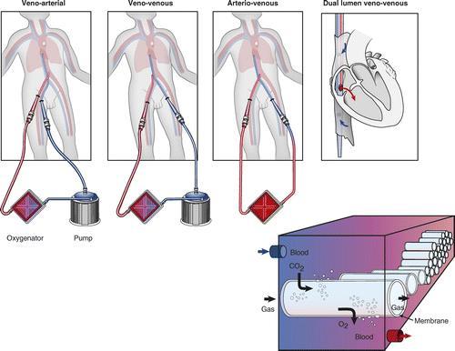 Extra-corporeal Membrane Oxygenation (ECMO)