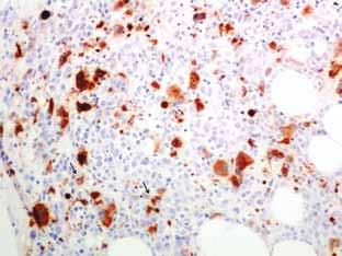Ιστοπαθολογικά χαρακτηριστικά μυελοδυσπλαστικών συνδρόμων 189 Εικόνα 2. Ανοσοϊστοχημική χρώση για CD61 υπογραμμίζει τα μεγακαρυοκύτταρα.