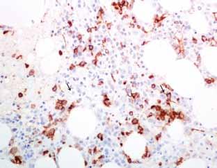 190 Ελένη Π. Κουρέα και Άννα Τασίδου Εικόνα 4. Ανοσοϊστοχημική χρώση για CD34 αναδεικνύει τα βλαστικά κύτταρα και την παρουσία αθροίσεών τους σε μη παραδοκιδώδη εντόπιση (ΑLIP). Εικόνα 5.