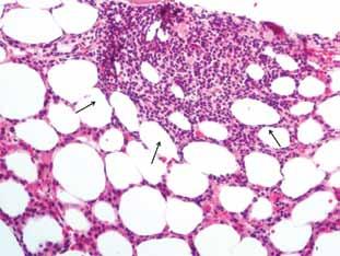 Ιστοπαθολογικά χαρακτηριστικά μυελοδυσπλαστικών συνδρόμων 191 Εικόνα 6. Λεμφοειδής άθροιση (βέλη) σε νορμοκυτταρικό μυελοδυσπλαστικό σύνδρομο ασθενούς 76 ετών. κλεισμό ΜΔΣ.