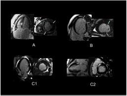 MRI scar and arrhythmic death CMR LGE in NICM patients strongly predicts adverse cardiac outcomes (hospitalization for heart failure, appropriate ICD firing, and cardiac death).