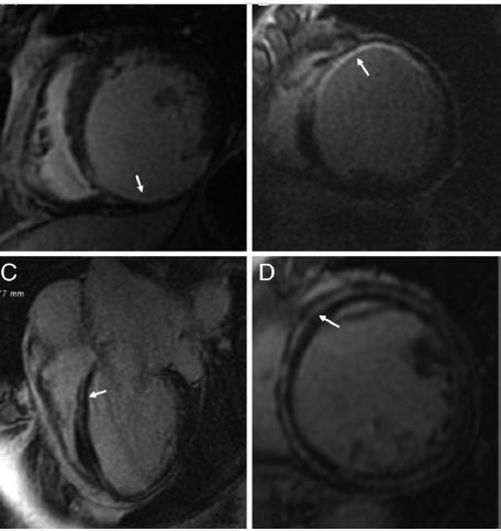 Left Ventricular Midwall Fibrosis as a Predictor of Mortality and Morbidity After Cardiac