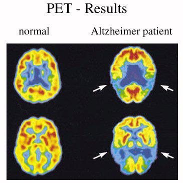 Positron Emission Tomography