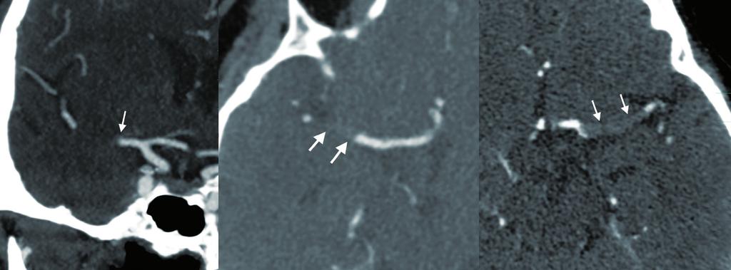 19 A B γ Εικόνα 2. Η αξονική αγγειογραφία (CTA) απεικονίζει την απόφραξη της δεξιάς μέσης εγκεφαλικής αρτηρίας (ΜΕΑ) (βέλη). (Α) Στεφανιαίες και (Β) εγκάρσιες ανασυνθέσεις.