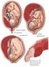 Διαταραχές πλακούντα - αμνιακού υγρού και σχέση με την κύηση το έμβρυο και το νεογνό