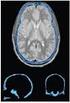 Mandibular Canal Segmentation Based on Shape-Driven Level-set Algorithm Restrained by Local Information