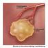 The role of transanterial embolization of the renal cell carcinomas (RCC) in elderly and unfit for surgical treatment patients.